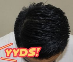 -大麦微针植发丨全国连锁