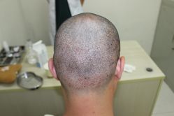 点击看大图 -大麦微针植发丨全国连锁