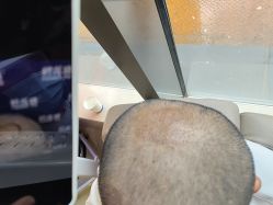 -碧莲盛·不剃发植发