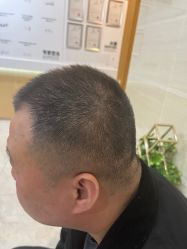 -大麦微针植发丨全国连锁