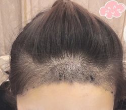 -大麦微针植发丨全国连锁