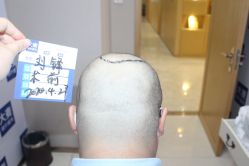 -大麦微针植发丨全国连锁