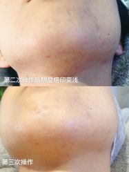 -觅屿日式脱毛美肤