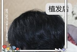 -大麦微针植发全国连锁