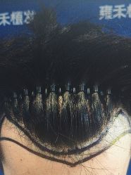 -雍禾植发全国连锁