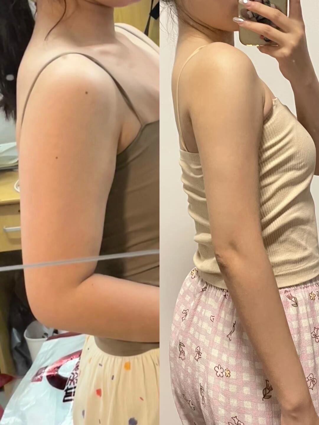 吸脂后对比