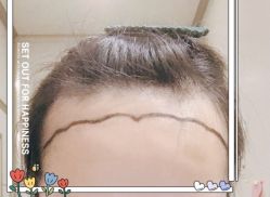 -大麦微针植发全国连锁