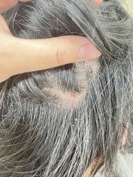 -菩叶脱发白发中心