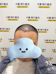 -大麦微针植发全国连锁