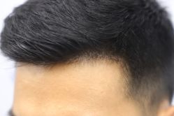 -大麦微针植发丨全国连锁