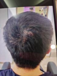 -大麦微针植发丨全国连锁