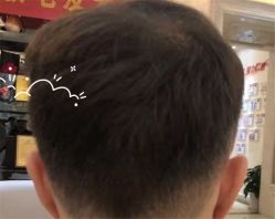 -大麦微针植发全国连锁
