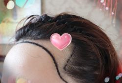 -大麦微针植发全国连锁