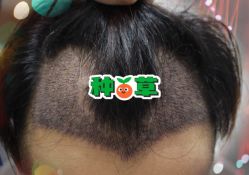 -大麦微针植发全国连锁