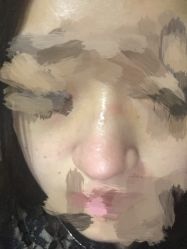 -成都苗方清颜专业祛痘