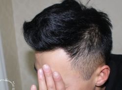 -大麦微针植发丨全国连锁