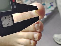 -祖传修脚甲沟炎灰指甲鸡眼