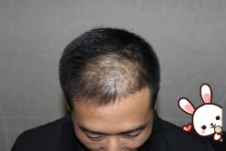 -大麦微针植发丨全国连锁