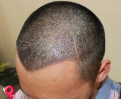 -大麦微针植发丨全国连锁