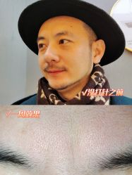 体验前-More摩尔医美の注射线雕光电中心
