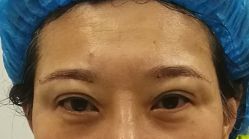 体验后-紫洁俪方（北京）医疗美容