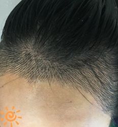 -大麦微针植发丨全国连锁