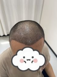 体验后-大麦微针植发全国连锁