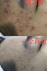 -靓芙泉专研痘痘肌