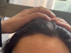 -碧莲盛·不剃发植发