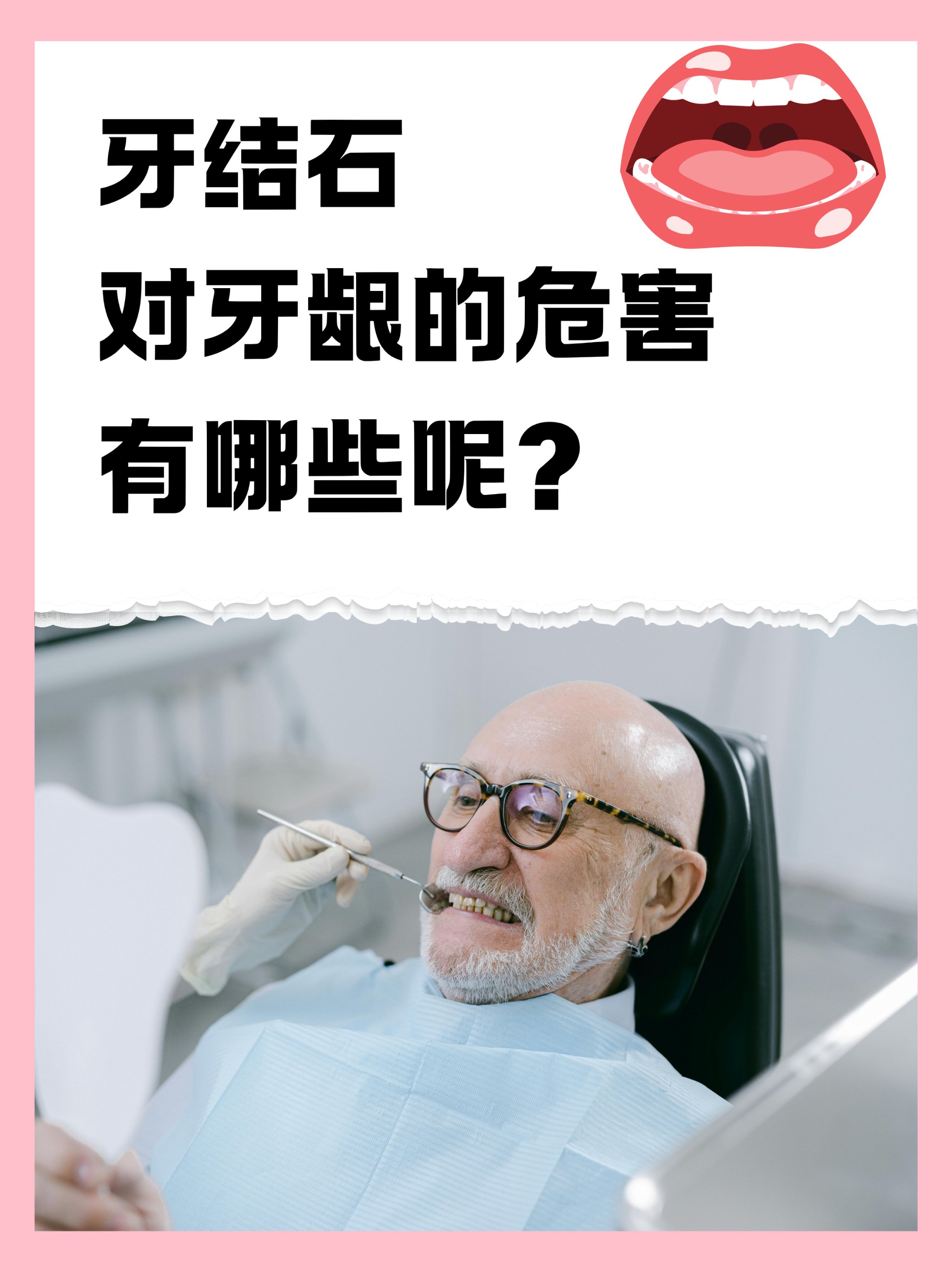 牙结石的危害图片