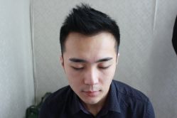 点击看大图 -大麦微针植发丨全国连锁