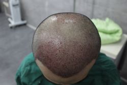 点击看大图 -大麦微针植发丨全国连锁