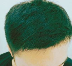 -大麦微针植发丨全国连锁