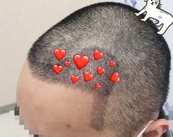 -大麦微针植发全国连锁