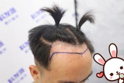 点击看大图 -大麦微针植发丨全国连锁