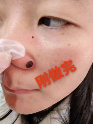 -北京美痣堂古方祛痣斑疣瘊