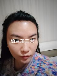 -碧莲盛·不剃发植发