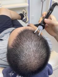 -大麦微针植发全国连锁