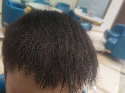 -碧莲盛·不剃发植发