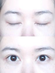 -广州健丽·去眼袋医疗美容机构