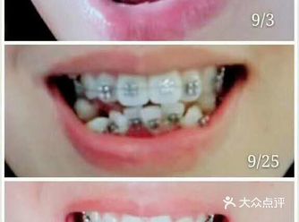 正畸的原理 矫正过后牙齿会不会松动呢？