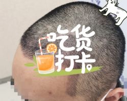 -大麦微针植发全国连锁