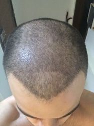 -大麦微针植发丨全国连锁