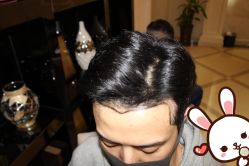 点击看大图 -大麦微针植发丨全国连锁