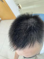 -大麦微针植发丨全国连锁