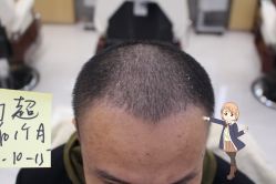 -大麦微针植发丨全国连锁