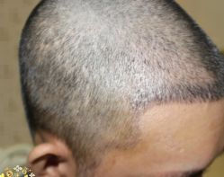 -大麦微针植发丨全国连锁