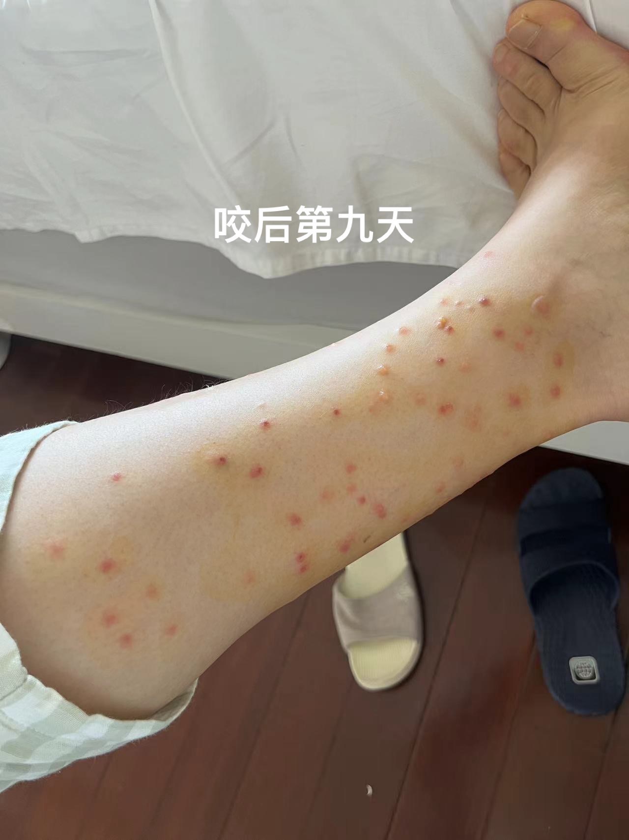 谁懂啊家人们,啥虫子给我咬的呀!