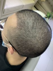 -大麦微针植发全国连锁