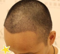 -大麦微针植发丨全国连锁